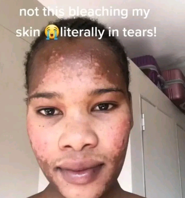 Ladies beware of products you apply on your face, this happened to her after using face bleach 3